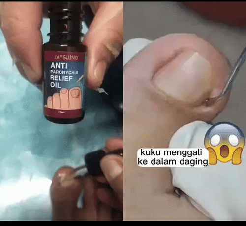 Combo 4 En 1 Suero Anti Hongos